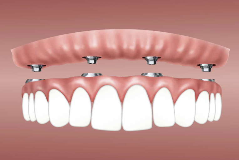 Implant-supported Dentures