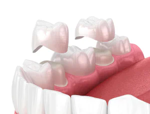3D dental illustration showing upper teeth and gums with translucent crowns or veneers positioned above teeth to demonstrate fitting process.