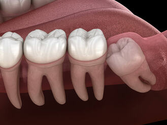 A dental illustration shows molars and surrounding gum tissue, highlighting tooth structure and positioning within the jaw.